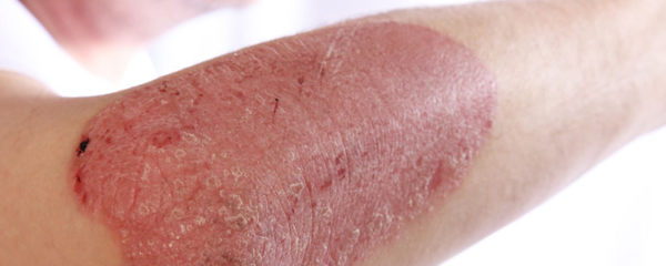 psoriasis en goutte