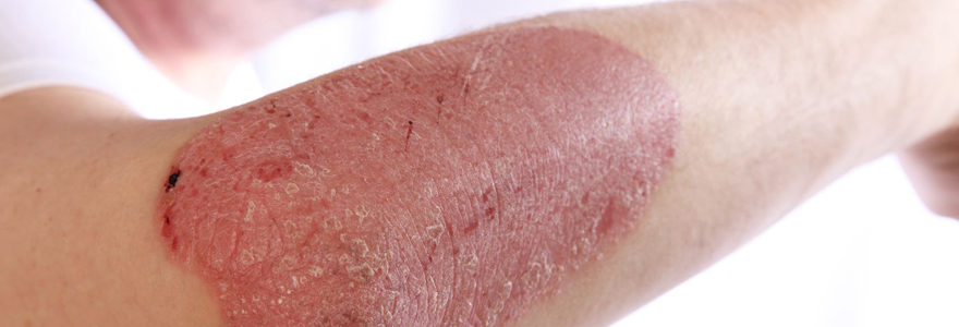 psoriasis en goutte